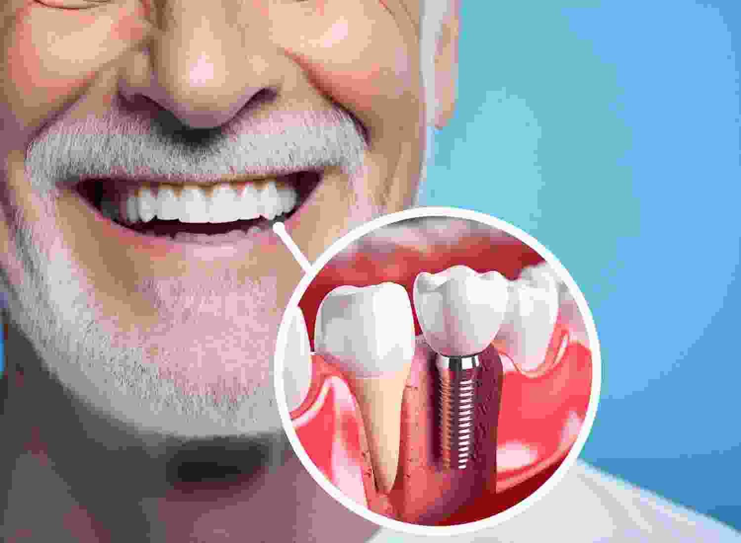 Dental Implants